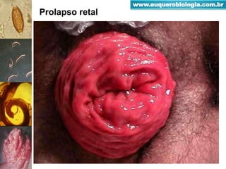 Prolapso retal
www.euquerobiologia.com.br
 