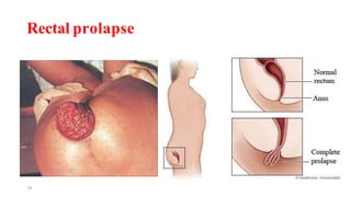 Rectal prolapse
14
 
