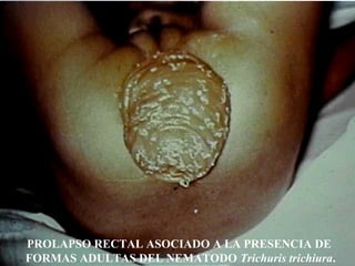 PROLAPSO RECTAL ASOCIADO A LA PRESENCIA DE
FORMAS ADULTAS DEL NEMATODO Trichuris trichiura.
 