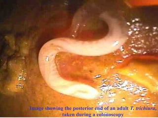 Image showing the posterior end of an adult T. trichiura,
             taken during a colonoscopy
 