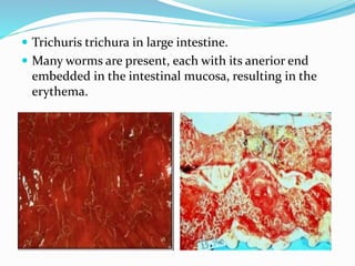  Trichuris trichura in large intestine.
 Many worms are present, each with its anerior end
embedded in the intestinal mucosa, resulting in the
erythema.
 