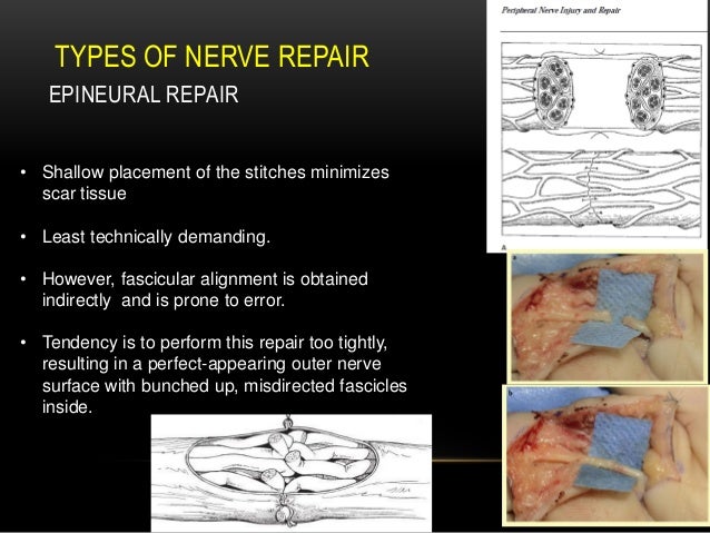 The Surgical Repair Of A Nerve Medical Term Trick and tips of nerve repair