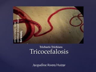 { 
Trichuris Trichiura 
Tricocefalosis 
Jacqueline Rivera Huizar 
 