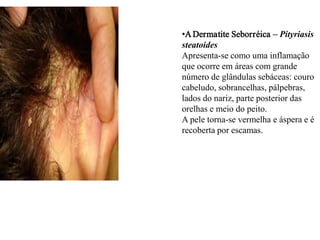 •A Dermatite Seborréica – Pityriasis
steatoides
Apresenta-se como uma inflamação
que ocorre em áreas com grande
número de glândulas sebáceas: couro
cabeludo, sobrancelhas, pálpebras,
lados do nariz, parte posterior das
orelhas e meio do peito.
A pele torna-se vermelha e áspera e é
recoberta por escamas.

 