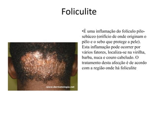 Foliculite
•É uma inflamação do folículo pilosebáceo (orifício de onde originam o
pêlo e o sebo que protege a pele).
Esta inflamação pode ocorrer por
vários fatores, localiza-se na virilha,
barba, nuca e couro cabeludo. O
tratamento desta afecção é de acordo
com a região onde há foliculite

 