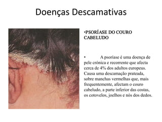 Doenças Descamativas
•PSORÍASE DO COURO
CABELUDO

•
A psoríase é uma doença de
pele crónica e recorrente que afecta
cerca de 4% dos adultos europeus.
Causa uma descamação prateada,
sobre manchas vermelhas que, mais
frequentemente, afectam o couro
cabeludo, a parte inferior das costas,
os cotovelos, joelhos e nós dos dedos.

 