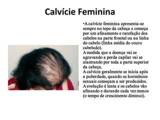 Calvície Feminina
         •A calvície feminina apresenta-se
         sempre no topo da cabeça e começa
         por um afinamento e rarefação dos
         cabelos na parte frontal ou na linha
         do cabelo (linha média do couro
         cabeludo).
         A medida que a doença vai se
         agravando a perda capilar vai se
         alastrando por toda a parte superior
         da cabeça.
         A calvície geralmente se inicia após
         a puberdade, quando os hormônios
         sexuais começam a ser produzidos.
         A evolução é lenta e os cabelos vão
         afinando e durando cada vez menos
         (o tempo de crescimento diminui).
 