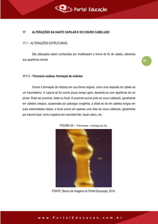 41
17 ALTERAÇÕES DA HASTE CAPILAR E DO COURO CABELUDO
17.1 – ALTERAÇÕES ESTRUTURAIS
São alterações assim conhecidas por modificarem a forma do fio de cabelo, alterando
sua aparência normal.
17.1.1 - Tricorexis nodosa: formação de nódulos
Ocorre a formação de nódulos em sua forma original, como uma resposta do cabelo ao
um traumatismo. A ruptura do fio ocorre pouco tempo após, deixando-os com aparência de um
pincel. Pode ser proximal, distal ou focal. A proximal ocorre junto ao couro cabeludo, geralmente
em cabelos crespos, ocasionada por patologia congênita; a distal se dá em cabelos longos em
suas extremidades distais; a focal ocorre em apenas uma área do couro cabeludo, geralmente
por trauma local, como coçadura em neurodermite, líquen plano, etc.
FIGURA 24 – Tricorrexe - inchaço do fio.
FONTE: Banco de imagens do Portal Educação, 2014.
 