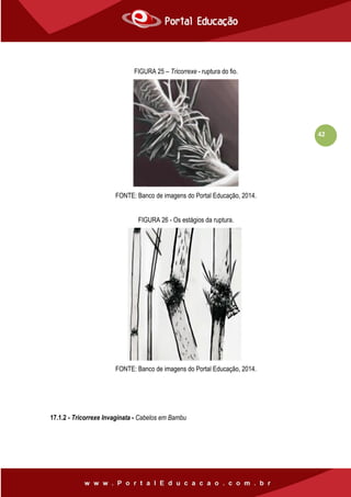 42
FIGURA 25 – Tricorrexe - ruptura do fio.
FONTE: Banco de imagens do Portal Educação, 2014.
FIGURA 26 - Os estágios da ruptura.
FONTE: Banco de imagens do Portal Educação, 2014.
17.1.2 - Tricorrexe Invaginata - Cabelos em Bambu
 