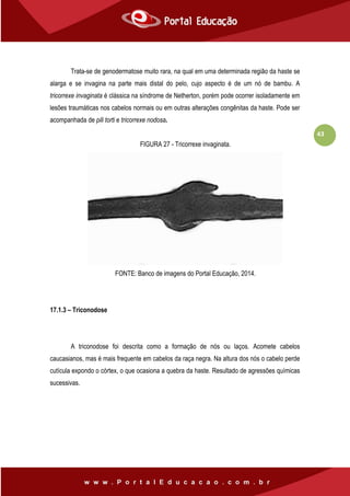 43
Trata-se de genodermatose muito rara, na qual em uma determinada região da haste se
alarga e se invagina na parte mais distal do pelo, cujo aspecto é de um nó de bambu. A
tricorrexe invaginata é clássica na síndrome de Netherton, porém pode ocorrer isoladamente em
lesões traumáticas nos cabelos normais ou em outras alterações congênitas da haste. Pode ser
acompanhada de pili torti e tricorrexe nodosa.
FIGURA 27 - Tricorrexe invaginata.
FONTE: Banco de imagens do Portal Educação, 2014.
17.1.3 – Triconodose
A triconodose foi descrita como a formação de nós ou laços. Acomete cabelos
caucasianos, mas é mais frequente em cabelos da raça negra. Na altura dos nós o cabelo perde
cutícula expondo o córtex, o que ocasiona a quebra da haste. Resultado de agressões químicas
sucessivas.
 