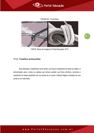 44
FIGURA 28 - Triconodose.
FONTE: Banco de imagens do Portal Educação, 2014.
17.1.4 - Tricoptilose: pontas partidas
Esta alteração é classificada como sendo uma fissura longitudinal da haste do cabelo. A
denominação seria a todos os cabelos que tenham perdido sua forma cilíndrica, rachando e
quebrando em fiapos parecidos com as cerdas de um pincel. Cabelos frágeis e fendidos em sua
ponta ou em toda haste.
 