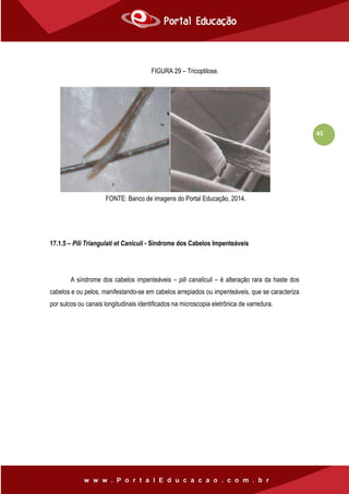 45
FIGURA 29 – Tricoptilose.
17.1.5 – Pili Triangulati et Caniculi - Síndrome dos Cabelos Impenteáveis
A síndrome dos cabelos impenteáveis – pili canaliculi – é alteração rara da haste dos
cabelos e ou pelos, manifestando-se em cabelos arrepiados ou impenteáveis, que se caracteriza
por sulcos ou canais longitudinais identificados na microscopia eletrônica de varredura.
32 – Tricoptilose. Fonte: www.sitri.it.
FONTE: Banco de imagens do Portal Educação, 2014.
 