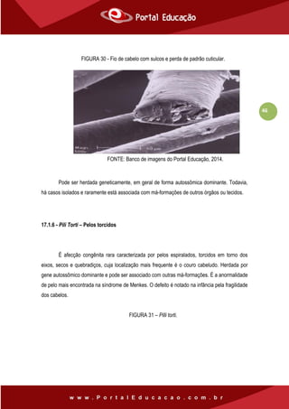 46
FIGURA 30 - Fio de cabelo com sulcos e perda de padrão cuticular.
Pode ser herdada geneticamente, em geral de forma autossômica dominante. Todavia,
há casos isolados e raramente está associada com má-formações de outros órgãos ou tecidos.
17.1.6 - Pili Torti – Pelos torcidos
É afecção congênita rara caracterizada por pelos espiralados, torcidos em torno dos
eixos, secos e quebradiços, cuja localização mais frequente é o couro cabeludo. Herdada por
gene autossômico dominante e pode ser associado com outras má-formações. É a anormalidade
de pelo mais encontrada na síndrome de Menkes. O defeito é notado na infância pela fragilidade
dos cabelos.
FIGURA 31 – Pilli torti.
FONTE: Banco de imagens do Portal Educação, 2014.
 