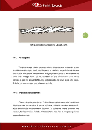 47
FONTE: Banco de imagens do Portal Educação, 2014.
17.1.7 - Pili Multigemini
Também chamados cabelos compostos, são considerados raros, embora não tenham
sido objeto de estudos para definir a real frequência na população em geral. O nome descreve
uma situação em que várias fibras separadas emergem para a superfície da pele através de um
único canal. Patologia mostra que na profundidade da pele estão situadas várias papilas
dérmicas e cada uma produzindo fibra, mas estão separadas no folículo piloso pelos bulbos.
Foliculite, por vezes, pode ser associada a esta condição.
17.1.8 – Tricoclasia: pontas desfiadas
É fratura comum da haste do pelo. Ocorrem fraturas transversas da haste, parcialmente
imobilizadas pela cutícula intacta. A cutícula, o córtex e o conteúdo de enxofre são anormais.
Pode ser confundida com tricorrexe ou tricoptilose. As pontas dos cabelos aparentam uma
vassoura, ficam desfibrados e desfiados. Trata-se da forma mais grave da Tricoptilose, porém as
causas são as mesmas.
 