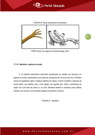 48
FIGURA 32- Figura esquemática da tricoclasia.
FONTE: Banco de imagens do Portal Educação, 2014.
17.1.9 – Moniletrix: cabelos em contas
É um distúrbio autossômico dominante caracterizado por cabelos que assumem um
aspecto em contas, apresentando uma haste que, periodicamente, torna-se mais fina. O fenótipo
resulta em fragilidade capilar e alopécia distrófica em placas. O termo moniletrix é derivado de
monile (latim), que significa colar, e thrix (grego), que significa pelo. Indica a semelhança do
cabelo com uma fieira de contas ou um colar. Moniletrix também é conhecida como cabelos
nodosos. Isto se deve a uma produção irregular de queratina no folículo.
FIGURA 33 – Moniletrix
 