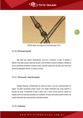 49
FONTE: Banco de imagens do Portal Educação, 2014.
17.1.10 - Pili Pseudo Annulati
São pelos que nascem obliquamente, encurvam e penetram na pele. O aspecto é
idêntico, mas difere porque nesse tipo de pelo o anel brilhante é devido à reflexão e refração da
luz por superfícies achatadas e torcidas do pelo, enquanto naquele tipo de pelo o anel mais claro
decorre de alterações internas, no córtex e medula.
17.1.11 – Pili recurvati – Pelos Encravados
Afecção frequente, principalmente em pelos da barba e da nuca, particularmente em
negros. Os pelos encravados podem causar uma reação inflamatória tipo corpo estranho e
foliculite da barba. O tratamento é fazer a barba com o menor trauma possível, usando em
seguida creme de corticoide associado com antibiótico. Os pelos encravados podem causar uma
reação inflamatória tipo corpo estranho e foliculite da barba.
17.1.12 – Pediculose
 