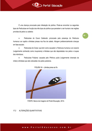 50
É uma doença provocada pela infestação de piolhos. Pode-se encontrar os seguintes
tipos de Pediculose em função dos três tipos de piolhos que parasitam o ser humano nas regiões
providas de pelos ou cabelos:
 Pediculose do Couro Cabeludo: provocada pela presença do Pediculus
humanus var capitis e lêndeas presas nos fios de cabelo. Atingem preferencialmente crianças
em fase escolar;
 Pediculose do Corpo: que tem como causador o Pediculus humanus var corporis
(vulgarmente conhecido como muquirana) e lêndeas que são depositadas nos pelos e roupas
dos indivíduos;
 Pediculose Pubiana: causada pelo Phthirus pubis (vulgarmente chamado de
chato) e lêndeas que são colocadas nos pelos pubianos.
FIGURA 34 – Lêndea presa ao fio
FONTE: Banco de imagens do Portal Educação, 2014.
17.2 ALTERAÇÕES QUANTITATIVAS
 