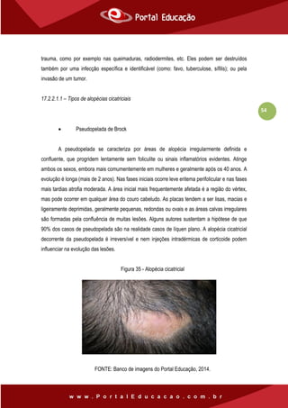 54
trauma, como por exemplo nas queimaduras, radiodermites, etc. Eles podem ser destruídos
também por uma infecção específica e identificável (como: favo, tuberculose, sífilis); ou pela
invasão de um tumor.
17.2.2.1.1 – Tipos de alopécias cicatriciais
 Pseudopelada de Brock
A pseudopelada se caracteriza por áreas de alopécia irregularmente definida e
confluente, que progridem lentamente sem foliculite ou sinais inflamatórios evidentes. Atinge
ambos os sexos, embora mais comumentemente em mulheres e geralmente após os 40 anos. A
evolução é longa (mais de 2 anos). Nas fases iniciais ocorre leve eritema perifolicular e nas fases
mais tardias atrofia moderada. A área inicial mais frequentemente afetada é a região do vértex,
mas pode ocorrer em qualquer área do couro cabeludo. As placas tendem a ser lisas, macias e
ligeiramente deprimidas, geralmente pequenas, redondas ou ovais e as áreas calvas irregulares
são formadas pela confluência de muitas lesões. Alguns autores sustentam a hipótese de que
90% dos casos de pseudopelada são na realidade casos de líquen plano. A alopécia cicatricial
decorrente da pseudopelada é irreversível e nem injeções intradérmicas de corticoide podem
influenciar na evolução das lesões.
Figura 35 - Alopécia cicatricial
FONTE: Banco de imagens do Portal Educação, 2014.
 