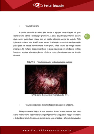 55
 Foliculite Decalvante
A foliculite decalvante é o termo geral em que se agrupam várias situações nas quais
ocorre foliculite crônica e cicatrização progressiva. A causa da patologia permanece obscura
ainda, porém parece haver relação com um estado seborreico anormal do paciente. Afeta
tipicamente mulheres entre 30 a 60 anos e homens da adolescência em diante. Qualquer região
pilosa pode ser afetada, individualmente ou em grupo, sendo o curso da doença bastante
prolongado. Há múltiplas áreas arredondadas ou ovais circundadas por coleções de pústulas
foliculares, seguidas pela destruição dos folículos e produzindo extensas áreas de alopécia
cicatricial.
FIGURA 36 - Foliculite decalvante, um tipo de alopécia cicatricial.
FONTE: Banco de imagens do Portal Educação, 2014.
 Foliculite dissecante (ou perifolliculitis capitis abscedens et suffodiens).
Afeta principalmente negros, do sexo masculino, de 18 a 40 anos de idade. Tem como
evento desencadeante a obstrução folicular por hiperqueratose, seguida de infecção secundária
e destruição do folículo. Desse modo, compõe com a acne conglobata e a hidradenite supurativa
 