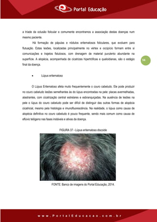 56
a tríade da oclusão folicular e comumente encontramos a associação destas doenças num
mesmo paciente.
Há formação de pápulas e nódulos eritematosos foliculares, que evoluem para
flutuação. Estas lesões, localizadas principalmente no vértex e occipício formam entre si
comunicações e trajetos fistulosos, com drenagem de material purulento abundante na
superfície. A alopécia, acompanhada de cicatrizes hipertróficas e queloidianas, são o estágio
final da doença.
 Lúpus eritematoso
O Lúpus Eritematoso afeta muito frequentemente o couro cabeludo. Ele pode produzir
no couro cabeludo lesões semelhantes às do lúpus encontradas na pele: placas avermelhadas,
alastrantes, com cicatrização central estrelares e esbranquiçadas. Na ausência de lesões na
pele o lúpus do couro cabeludo pode ser difícil de distinguir das outras formas de alopécia
cicatricial, mesmo pela histologia e imunofluorescência. Na realidade, o lúpus como causa de
alopécia definitiva no couro cabeludo é pouco frequente, sendo mais comum como causa de
eflúvio telógeno nas fases instáveis e ativas da doença.
FIGURA 37 - Lúpus eritematoso discoide
FONTE: Banco de imagens do Portal Educação, 2014.
 