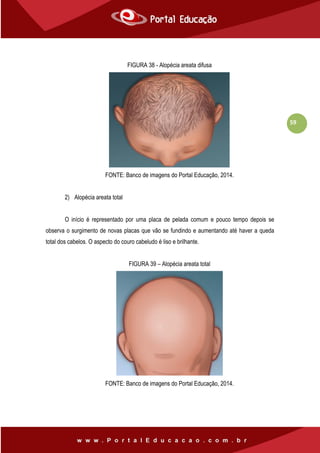 59
FIGURA 38 - Alopécia areata difusa
FONTE: Banco de imagens do Portal Educação, 2014.
2) Alopécia areata total
O início é representado por uma placa de pelada comum e pouco tempo depois se
observa o surgimento de novas placas que vão se fundindo e aumentando até haver a queda
total dos cabelos. O aspecto do couro cabeludo é liso e brilhante.
FIGURA 39 – Alopécia areata total
FONTE: Banco de imagens do Portal Educação, 2014.
 