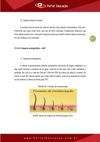 60
3) Alopécia Areata Universal
O indivíduo não tem pelos em nenhum local do corpo (cabelos, sobrancelhas, cílios, etc).
Felizmente são casos muito raros, pois são de difícil resolução. Antigamente achava-se que
tinha relação apenas com o emocional. Hoje já se sabe que também existem fatores autoimunes,
por isso melhoram com corticoide.
17.2.2.4- Alopécia androgenética – AAG
1) Alopécia Androgenética
A calvície é geneticamente definida (autossômica dominante de origem poligênica), ou
seja, basta somente a presença de um gene, vindo de um dos pais, para o filho manifestar a
patologia. Se o pai ou a mãe tem calvície, o filho tem 50% de chance de adquirir a mesma. Se
ambos os pais têm calvície (sendo que o lado materno positivo pode ser a presença de calvície
no avô materno) a chance aumenta para 75%.
FIGURA 40- Processo de miniaturização.
FONTE: Banco de imagens do Portal Educação, 2014.
 