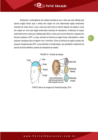 62
Analisando a embriogênese dos cabelos percebe-se que a área que será afetada pela
calvície (região frontal, topo e vértex) tem origem em uma determinada região embrionária
chamada de crista neural, e que a área que será imune à calvície (laterais da cabeça e nuca)
tem origem em uma outra região embrionária chamada de mesoderma. A diferença na origem
embrionária entre a área que é afetada pela AAG e a área que é imune influencia a resposta dos
folículos capilares a DHT, ou seja, somente os folículos da região frontal, intermediária e vértex
possuem receptores para se ligarem com o hormônio. Como os folículos da região occipital não
possuem receptores para DHT, nunca sofrendo a miniaturização, isso possibilita o tratamento da
calvície de forma definitiva, através do transplante de cabelos.
FIGURA 41– Divisão da cabeça.
FONTE: Banco de imagens do Portal Educação, 2014.
 