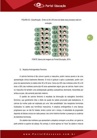63
FIGURA 42– Classificação - Entre os 20 e 50 anos de idade esse processo está em
evolução.
FONTE: Banco de imagens do Portal Educação, 2014.
2) Alopécia Androgenética Feminina
A calvície feminina é tão comum quanto a masculina, porém menos severa e de uma
apresentação clínica totalmente diferente. O início é gradual e após a puberdade, porém com
picos de aparecimento na idade entre 30 e 50 anos. Cerca de 25% das mulheres entre 25 e 40
anos e 50% das mulheres acima dos 40 anos apresentam algum grau de calvície. Assim como
na masculina há também uma predisposição genética autossômica dominante, transmitida por
ambos os pais, não somente pelo lado materno.
O padrão de calvície feminino é resultado da diminuição do estrogênio (hormônio
feminino), que geralmente inibe o efeito da queda de cabelo provocado pela testosterona. A
calvície da mulher pode ser explicada por uma “alta sensibilidade” dos receptores hormonais
localizados no cabelo aos hormônios masculinos. A alopécia androgenética é uma doença
progressiva que, se não for tratada, tende a piorar com o tempo. A velocidade de progressão
depende de fatores únicos em cada pessoa, tais como histórico familiar e presença ou ausência
de distúrbios hormonais.
Os cabelos das mulheres que apresentam a alopécia começam a se afinar, em geral na
parte anterior e superior da cabeça. No começo, é visível apenas na “risca” do cabelo e nota-se
 