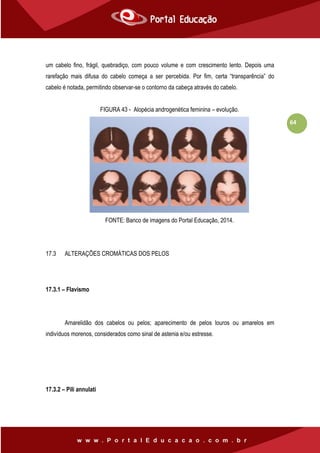 64
um cabelo fino, frágil, quebradiço, com pouco volume e com crescimento lento. Depois uma
rarefação mais difusa do cabelo começa a ser percebida. Por fim, certa “transparência” do
cabelo é notada, permitindo observar-se o contorno da cabeça através do cabelo.
FIGURA 43 - Alopécia androgenética feminina – evolução.
FONTE: Banco de imagens do Portal Educação, 2014.
17.3 ALTERAÇÕES CROMÁTICAS DOS PELOS
17.3.1 – Flavismo
Amarelidão dos cabelos ou pelos; aparecimento de pelos louros ou amarelos em
indivíduos morenos, considerados como sinal de astenia e/ou estresse.
17.3.2 – Pili annulati
 