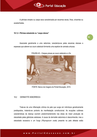 66
A pitiríase simplex ou caspa seca caracterizada por escamas secas, finas, cinzentas ou
acastanhadas.
18.1.2 - Pitiríase esteatoide ou “caspa oleosa”
Associada geralmente a uma seborreia, caracteriza-se pelas escamas oleosas e
espessas que aderem ao couro cabeludo formando uma espécie de camada untuosa.
FIGURA 45 – Caspas presas ao couro cabeludo e o fio.
FONTE: Banco de imagens do Portal Educação, 2014.
18.2 DERMATITE SEBORREICA
Trata-se de uma inflamação crônica da pele que surge em indivíduos geneticamente
predispostos, tratando-se portanto de manifestação constitucional. As erupções cutâneas
características da doença ocorrem predominantemente nas áreas de maior produção de
oleosidade pelas glândulas sebáceas. A causa da dermatite seborreica é desconhecida, mas a
oleosidade excessiva e um fungo (Pityrosporum ovale) presente na pele afetada estão
 