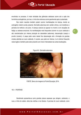 67
envolvidos no processo. A maior atividade das glândulas sebáceas ocorre sob a ação dos
hormônios androgênicos, por isso, o início dos sintomas ocorre geralmente após a puberdade.
Nos recém nascidos também podem ocorrer manifestações da doença, devido ao
androgênio materno ainda presente. Dermatite seborreica tem caráter crônico, com tendência a
períodos de melhora e de piora. A doença costuma se agravar no inverno e em situações de
fadiga ou estresse emocional. As manifestações mais frequentes ocorrem no couro cabeludo e
são caracterizados por intensa produção de oleosidade (seborreia), descamação (caspa) e
prurido (coceira). A caspa pode variar desde fina descamação até a formação de grandes
crostas aderidas ao couro cabeludo. A coceira, que pode ser intensa, é um sintoma frequente
nesta região e também pode estar presente com menor intensidade nas outras localizações.
Figura 46 - Dermatite seborreica.
FONTE: Banco de imagens do Portal Educação, 2014.
18.3 – PSORÍASE
Geralmente apresenta-se como grandes placas espessas que atingem, sobretudo, a
nuca, a linha do cabelo, atrás das orelhas e nos lóbulos. A psoríase do couro cabeludo, como
 