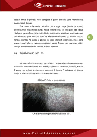 68
todas as formas de psoríase, não é contagiosa, e quando afeta esta zona geralmente não
aparece na pele do corpo.
Esta doença é facilmente confundida com a vulgar caspa (dermite ou eczema)
seborreica, muito frequente nos adultos, mas ao contrário desta, que afeta quase todo o couro
cabeludo, a psoríase forma placas muito distintas e deixa outras áreas livres, aparecendo zonas
bem delimitadas, quase como uma “touca” de pele avermelhada coberta por escamas ou como
manchas discretas. As causas da psoríase não estão totalmente esclarecidas, mas é ponto
assente que certos fatores podem agravá-la/desencadeá-la. Entre os mais importantes estão o
cansaço, a tensão emocional, o consumo de álcool e o tabaco.
18.4 TINHA DO COURO CABELUDO
Micose superficial que atinge o couro cabeludo, caracterizada por lesões eritematosas,
escamosas e alopécia tonsurante. Inicia-se com pequena lesão eritematosa, escamosa, folicular.
O quadro é de evolução crônica, com o surgimento de tonsura. A lesão pode ser única ou
múltipla. É rara no adulto, acomete principalmente as crianças.
FIGURA 47 - Tinha do couro cabeludo.
FONTE: Banco de imagens do Portal Educação, 2014.
 