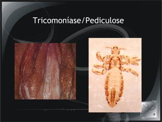 Tricomoníase/Pediculose 