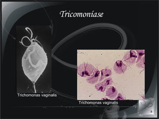 Tricomoníase Trichomonas vaginalis Trichomonas vaginalis 