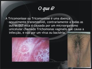 O que é? A Tricomoníase ou Tricomoniose é uma doença sexualmente transmissível, contrariamente a todas as outras DST esta é causada por um microorganismo unicelular chamado Trichomonas vaginalis que causa a infecção, e não por um vírus ou bactéria. 