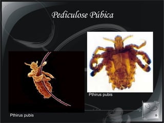 Pediculose Púbica Pthirus pubis  Pthirus pubis  