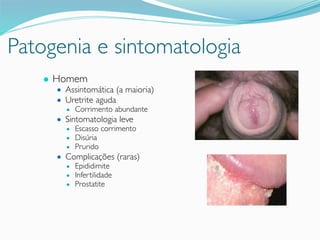 Patogenia e sintomatologia
● Homem
● Assintomática (a maioria)
● Uretrite aguda
● Corrimento abundante
● Sintomatologia leve
● Escasso corrimento
● Disúria
● Prurido
● Complicações (raras)
● Epididimite
● Infertilidade
● Prostatite
 