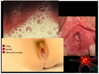 Diagnóstico
                      En las mujeres:

• Un examen pélvico muestra ronchas rojas en la pared
  vaginal o cuell...