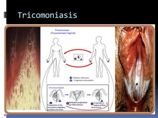 Tricomoniasis
 