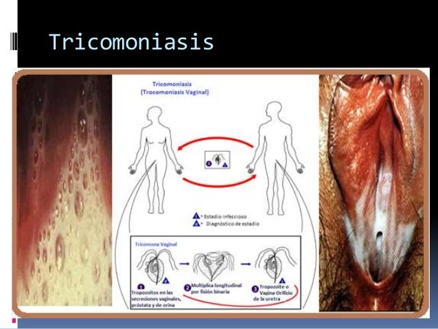 Resultado de imagen de tricomoniasis