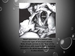 Heart specimen of a patient with
muscular type of tricuspid atresia.
Note dimple (arrow) in the floor of the
right atrium with muscle fibers radiating
around it. An atrial septal defect (ASD)
is also shown.
 