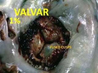 VALVAR
1%
FUSED CUSPS
 