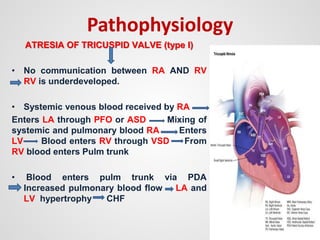 Pathophysiology
ATRESIA OF TRICUSPID VALVE (type I)
• No communication between RA AND RV
RV is underdeveloped.
• Systemic venous blood received by RA
Enters LA through PFO or ASD Mixing of
systemic and pulmonary blood RA Enters
LV Blood enters RV through VSD From
RV blood enters Pulm trunk
• Blood enters pulm trunk via PDA
Increased pulmonary blood flow LA and
LV hypertrophy CHF
 