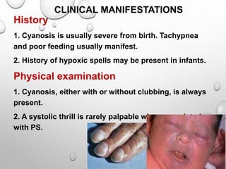 History
1. Cyanosis is usually severe from birth. Tachypnea
and poor feeding usually manifest.
2. History of hypoxic spells may be present in infants.
Physical examination
1. Cyanosis, either with or without clubbing, is always
present.
2. A systolic thrill is rarely palpable when associated
with PS.
CLINICAL MANIFESTATIONS
 