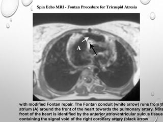 with modified Fontan repair. The Fontan conduit (white arrow) runs from th
atrium (A) around the front of the heart towards the pulmonary artery. Note
front of the heart is identified by the anterior atrioventricular sulcus tissue
containing the signal void of the right coronary artery (black arrow
 