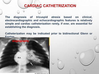 CARDIAC CATHETRIZATION
The diagnosis of tricuspid atresia based on clinical,
electrocardiographic and echocardiographic features is relatively
simple and cardiac catheterization rarely, if ever, are essential for
establishing the diagnosis.
Catheterization may be indicated prior to bidirectional Glenn or
Fontan
operations.
 