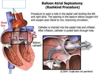 RASHKIND BALLOON ATRIAL
SEPTOSTOMY.
 