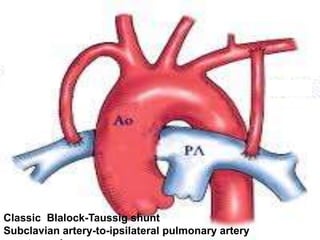 Classic Blalock-Taussig shunt
Subclavian artery-to-ipsilateral pulmonary artery
 