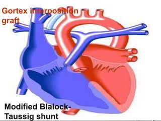 Modified Blalock-
Taussig shunt
Gortex interposition
graft
 