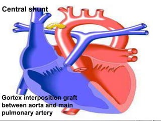 Central shunt
Gortex interposition graft
between aorta and main
pulmonary artery
 